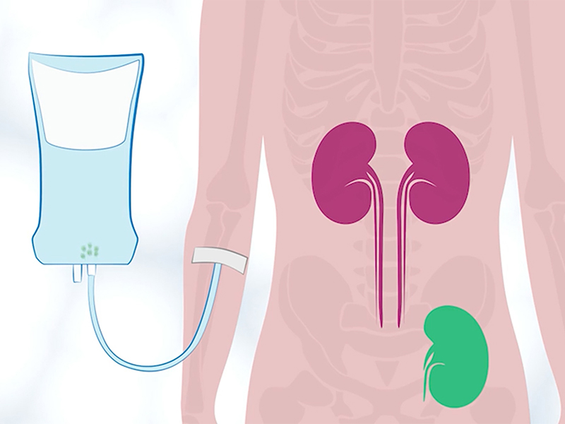 An illustration of a torso with three kidneys and an IV bag is shown going into the arm